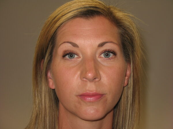 blonde lady before botox treatment