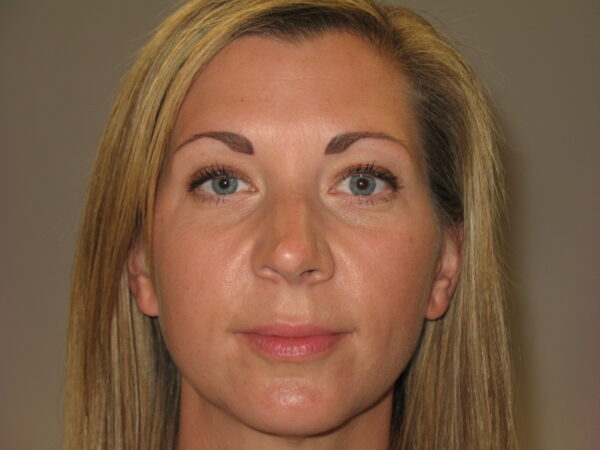 blonde lady after botox treatment