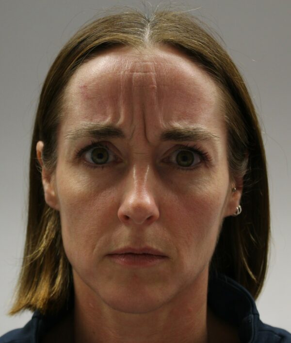 Botox before