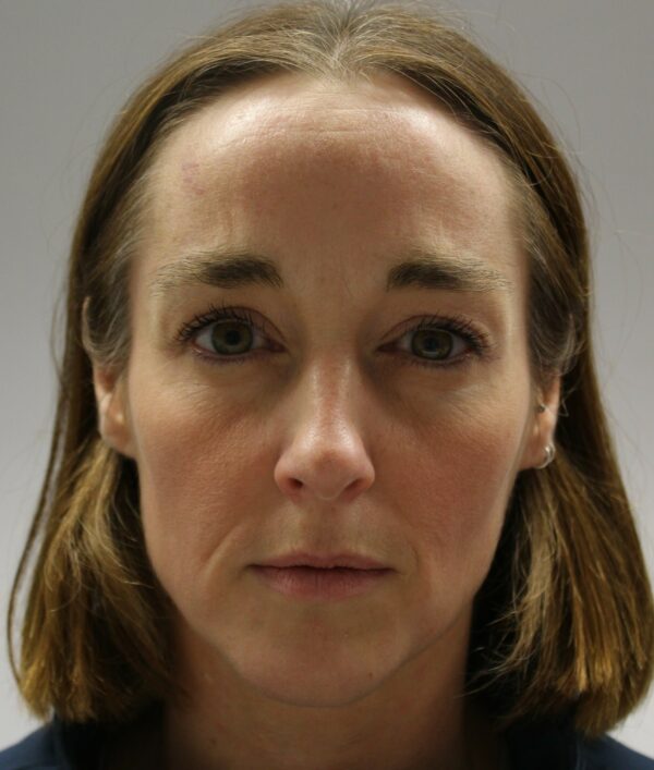 Botox after