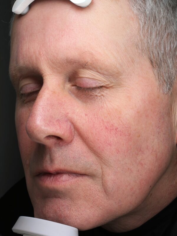 Image of man before BBL treatment