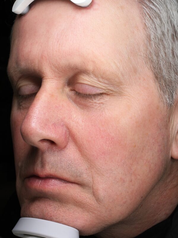 Image of man after BBL treatment after