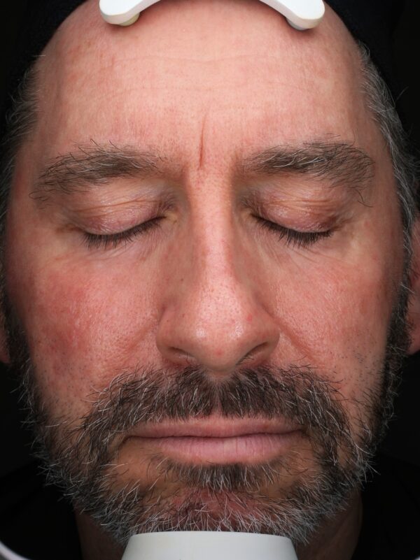 After Ultraclear Laser Course of Treatments at Woodford Medical Belfast