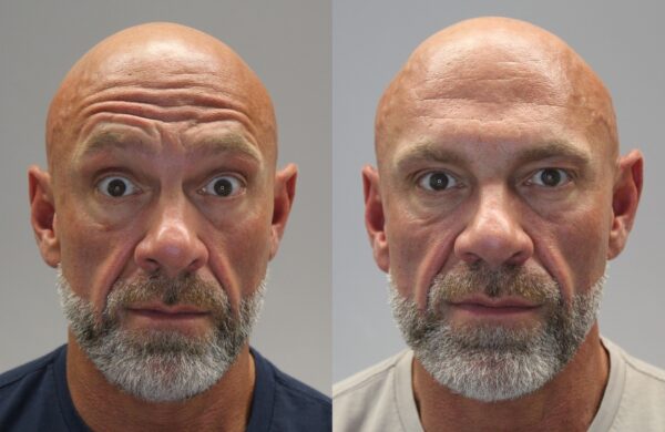 Anti wrinkle forehead before and after Woodford Medical Belfast