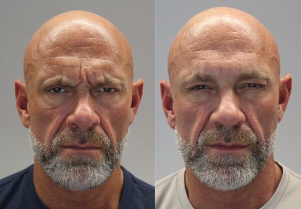 Anti wrinkle frown before and after Woodford Medical Belfast