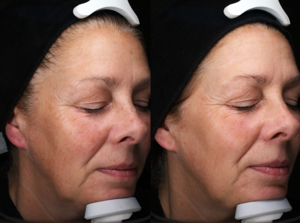 Image of a lady before and after BBL treatment
