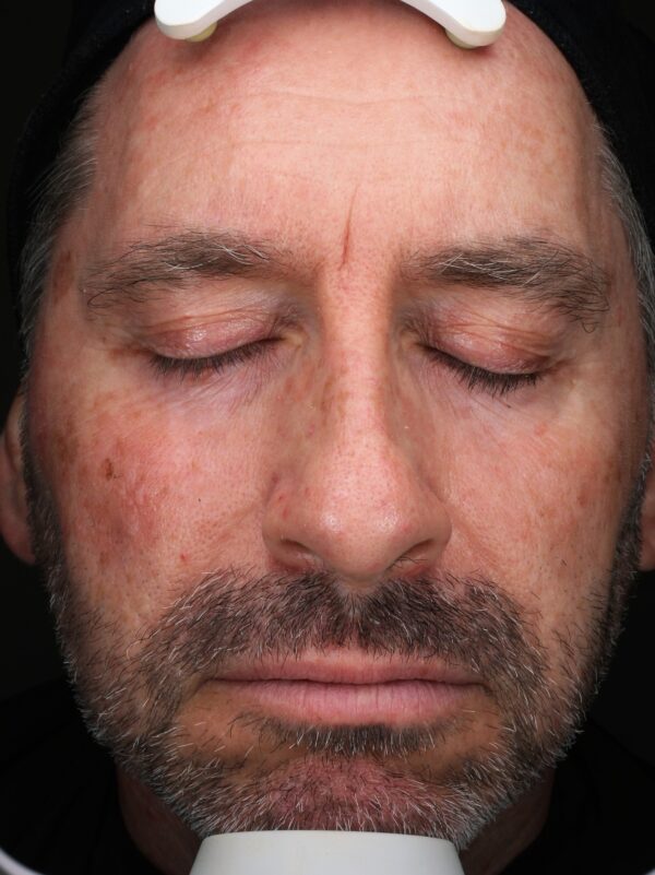 Before Ultraclear Laser Course of Treatments at Woodford Medical Belfast