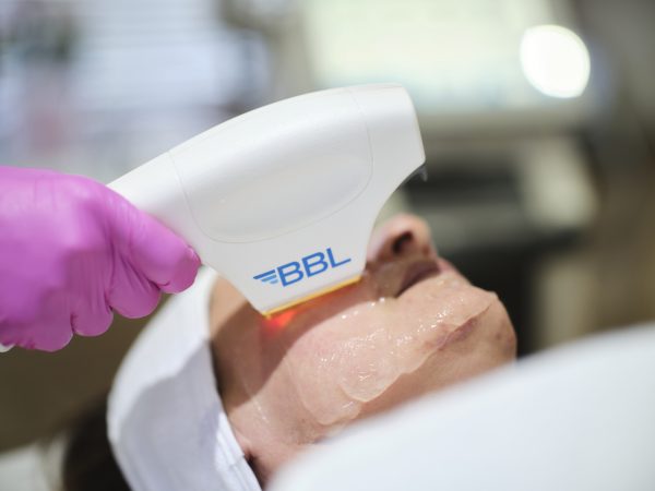 BBL Laser for Rosacea and Pigmentation