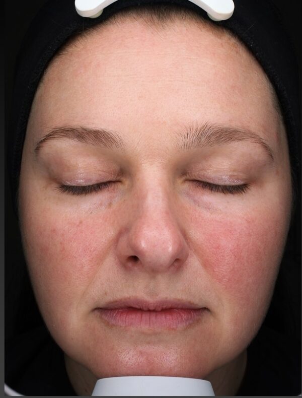 Images of lady with less red cheeks