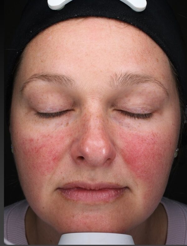 Image of lady with red flushed cheeks