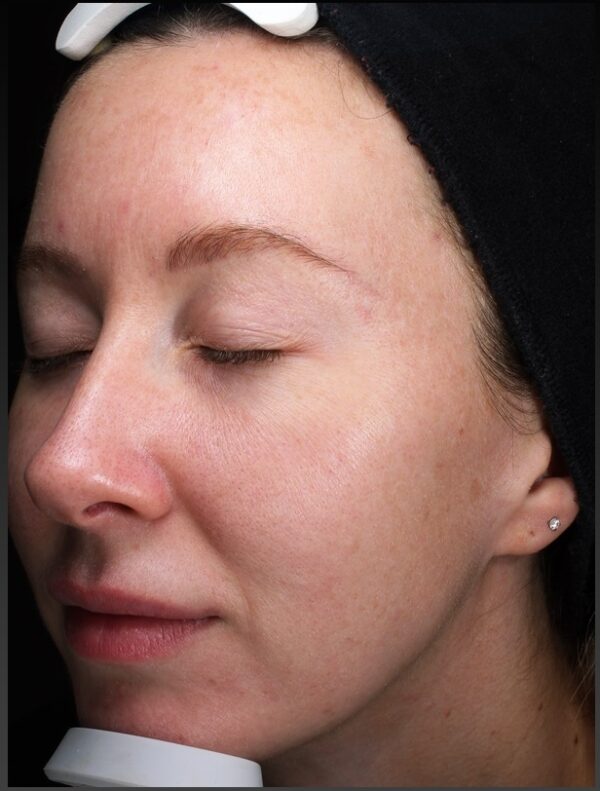 Image of lady after treatment