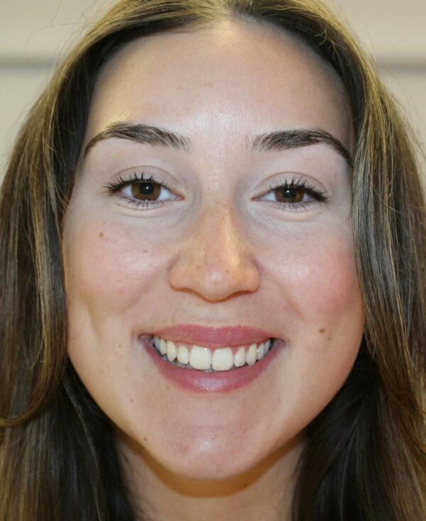 image of a lady with gummy smile corrected