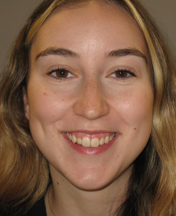 Image of lady before gummy smile