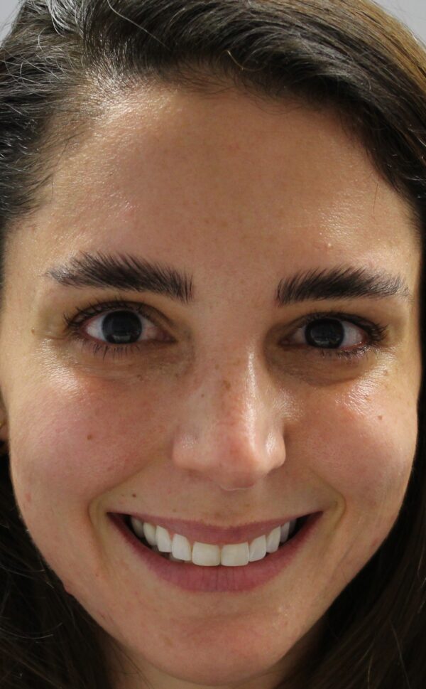 Gummy Smile Woodford Medical Belfast Anti Wrinkle Injections After