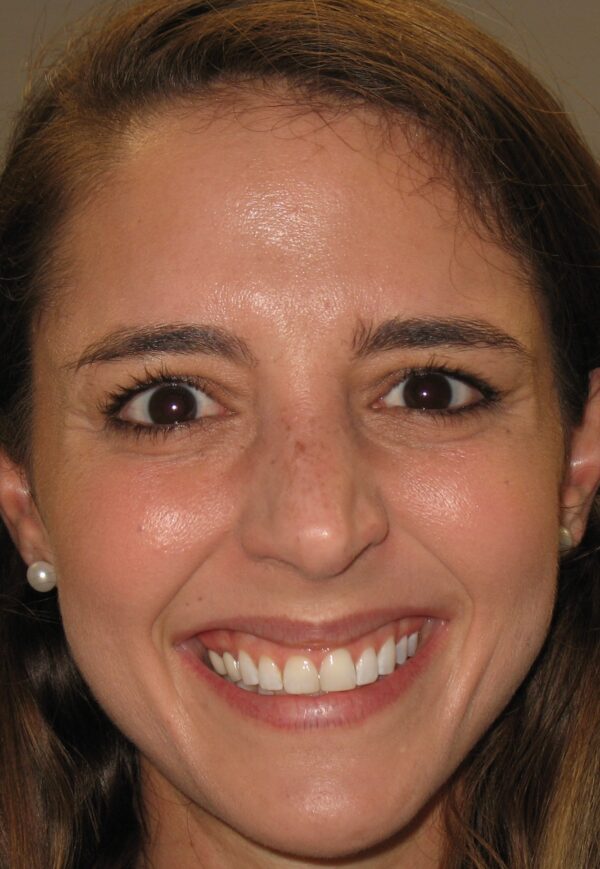 Gummy Smile Woodford Medical Belfast Anti Wrinkle Injections Before