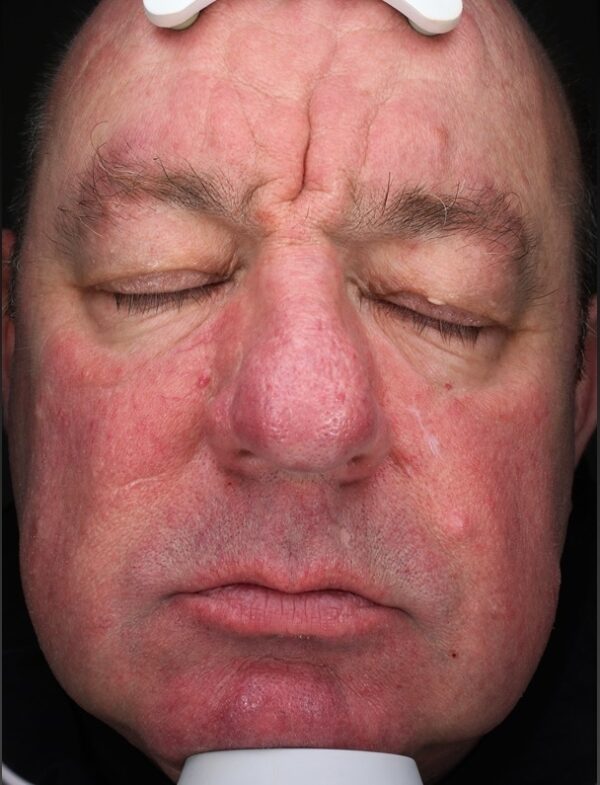 Image of gentleman after BBL
