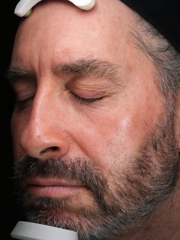 Left Cheek after Ultraclear Laser Treatment at Woodford Medical Belfast