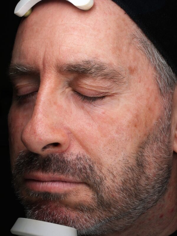 Left Cheek before Ultraclear Laser Treatment at Woodford Medical Belfast