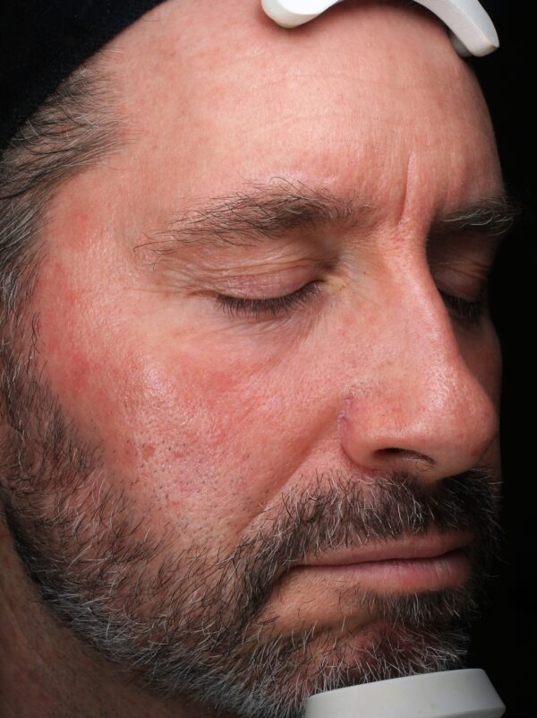 Right Cheek after Ultraclear Laser Treatment at Woodford Medical Belfast