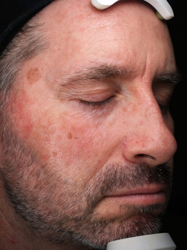 Right Cheek before Ultraclear Laser Treatment at Woodford Medical Belfast