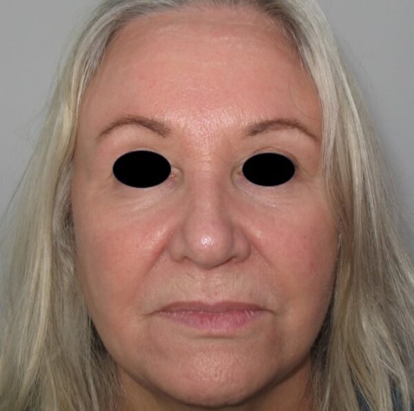 Image of lady after filler treatment