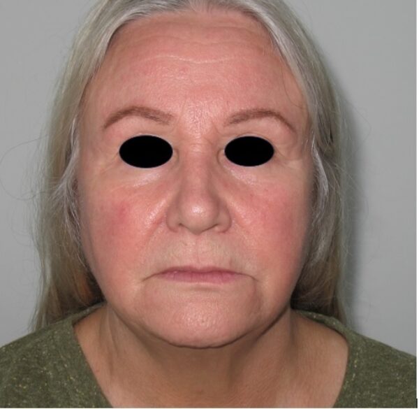 Image of lady before treatment