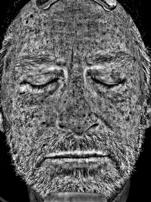 UV Image taken after two Ultraclear Laser Treatments at Woodford Medical Belfast