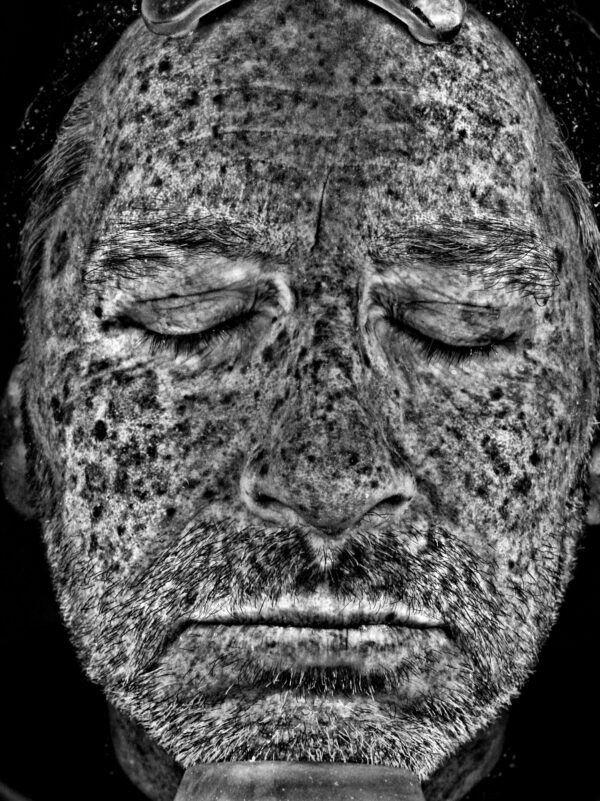 UV Image taken before Ultraclear Laser Treatment at Woodford Medical Belfast