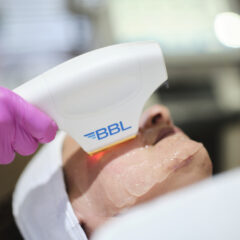 BBL Laser for Rosacea and Pigmentation