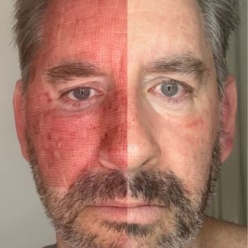 Ultraclear before and after photos