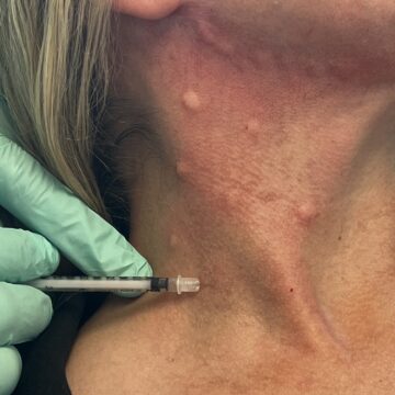 Botox Belfast – Full Face Balance on the Lisburn Road