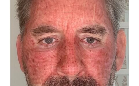 UltraClear laser Day 1 recovery photo UK