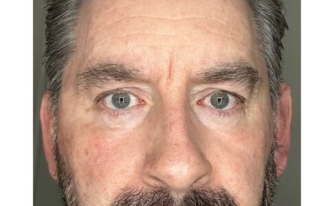 UltraClear laser Day 10 smoother texture