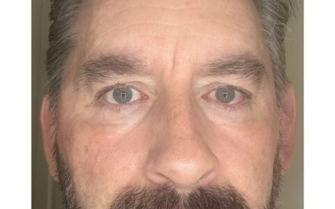 UltraClear laser Day 11 final result UK