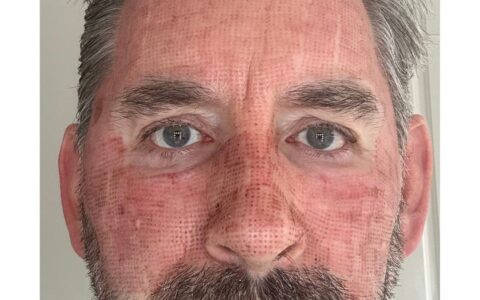 UltraClear laser Day 2 before and after progression