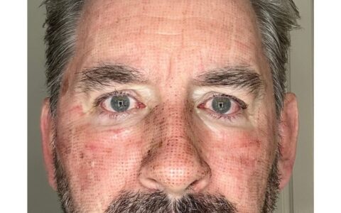 UltraClear laser Day 3 healing redness fading