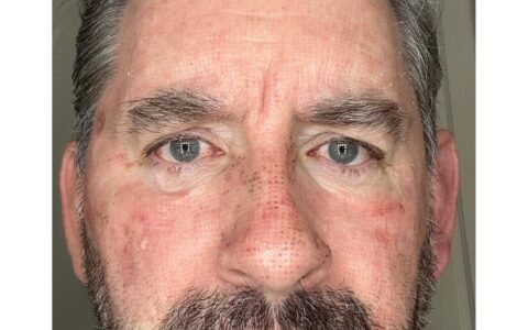 Laser skin resurfacing UK – UltraClear Day 4 recovery