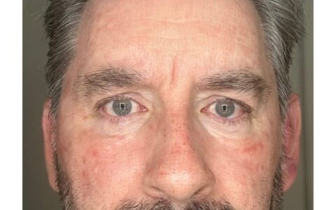 UltraClear laser Day 5 surface renewal begins