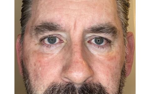 UltraClear laser Day 6 fresh skin appearing