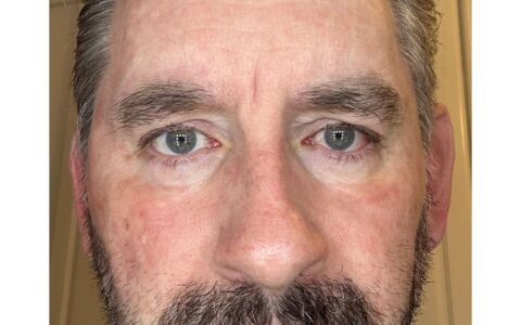 UltraClear laser Day 7 clearer complexion UK