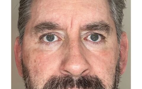 UltraClear laser Day 8 refinement phase