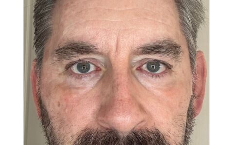 UltraClear laser Day 9 visible results UK